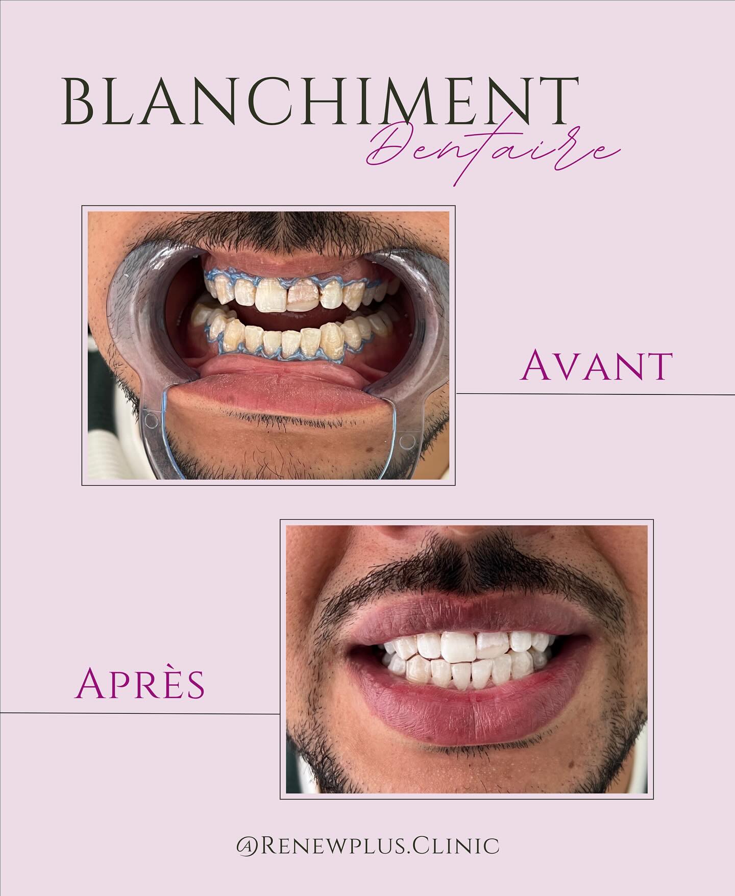 Avant Après blanchiment dentaire