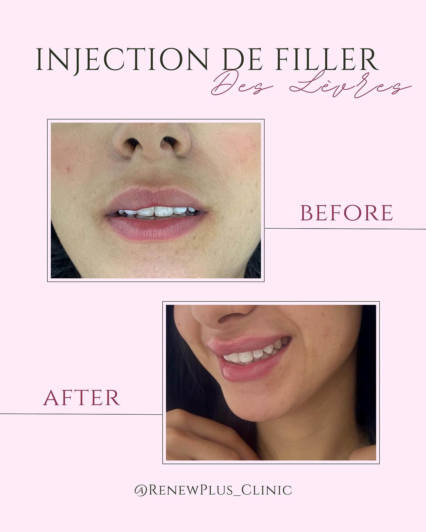 Avant Après filler lèvres 2