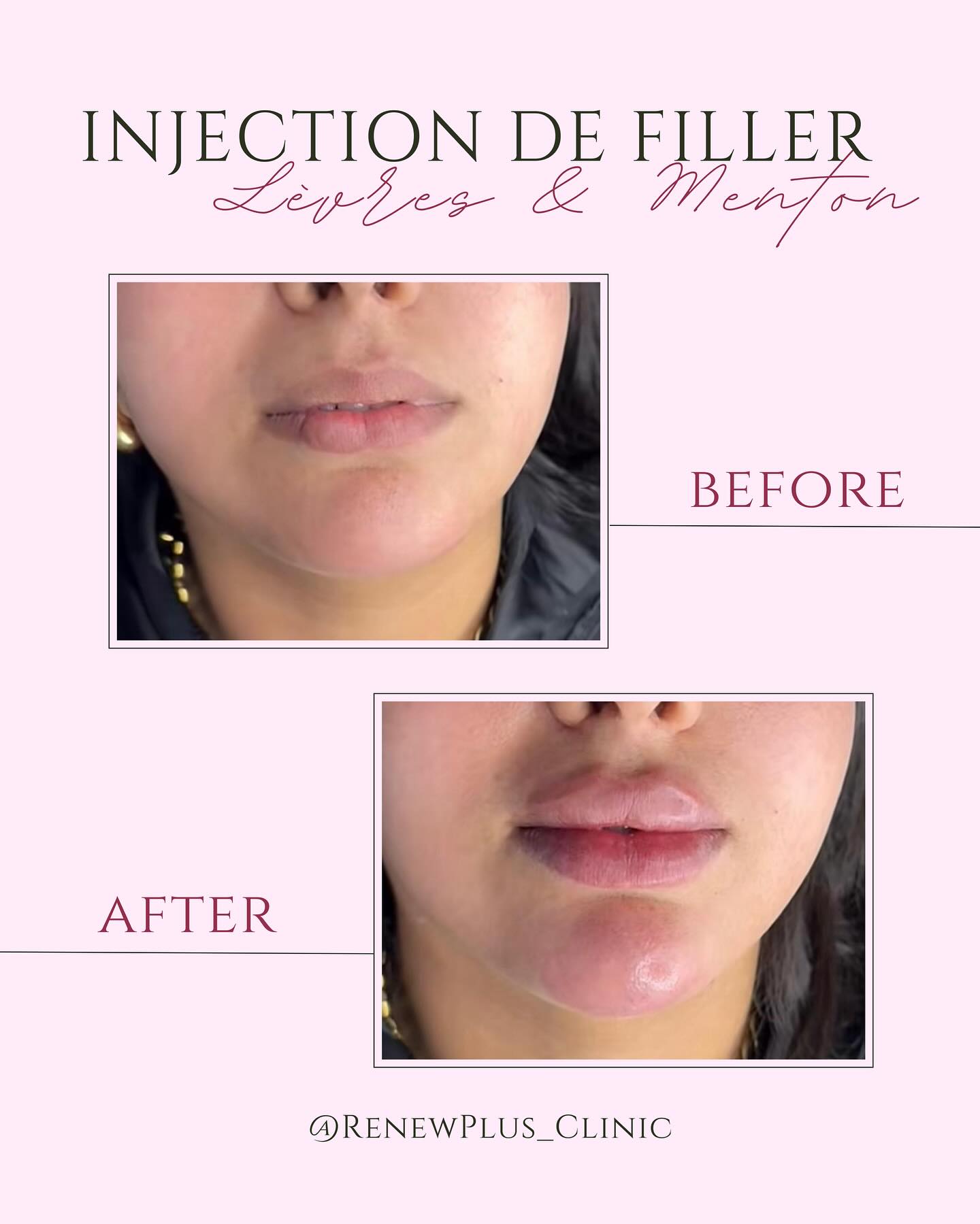 Avant Après filler lèvres menton