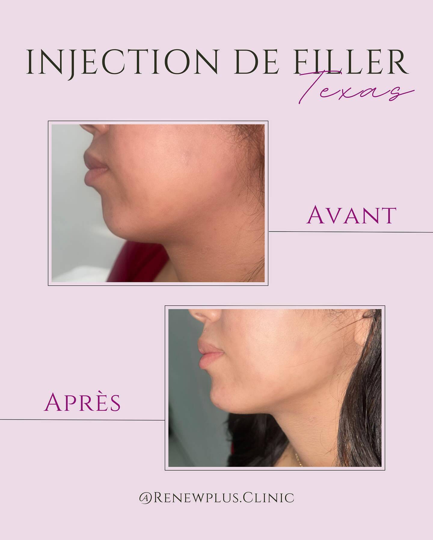 Avant Après filler mâchoire