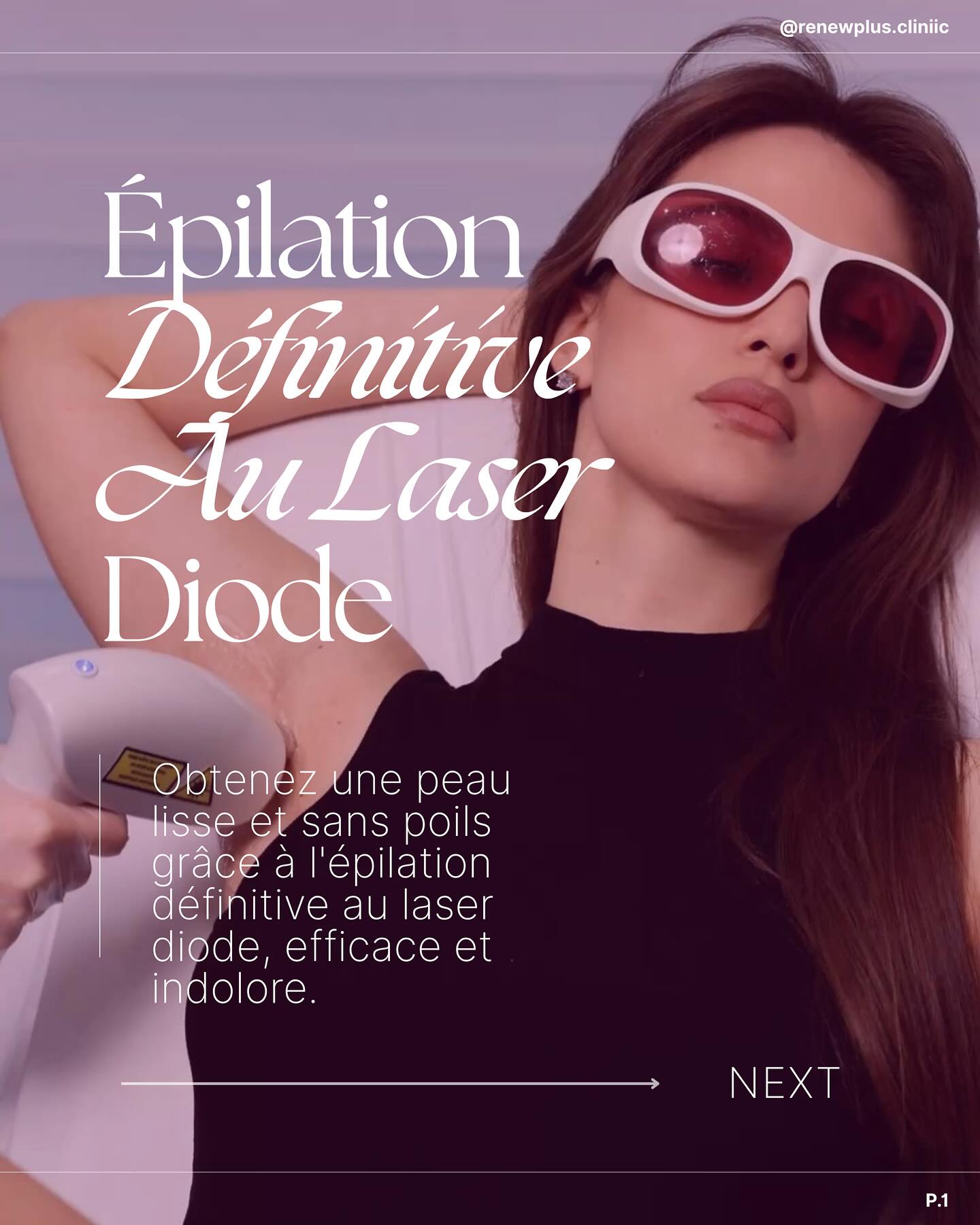 Épilation laser RenewPlus Clinic