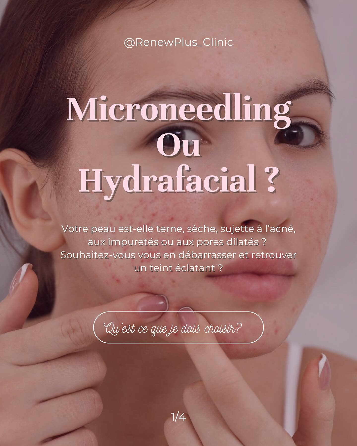 Microneedling vs HydraFacial RenewPlus Clinic